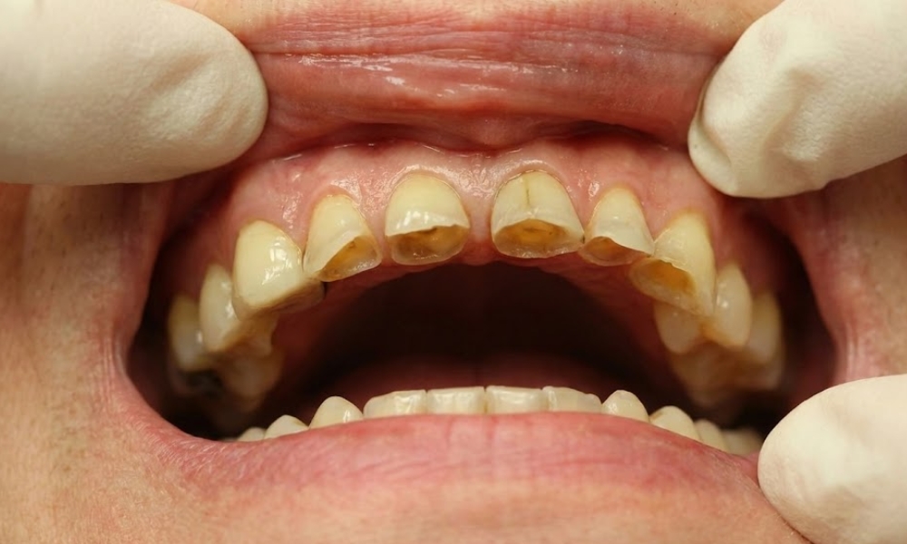 Erozija i trošenje zuba